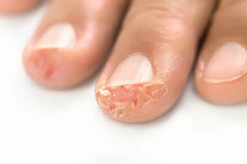 Psoriasi ungueale foto