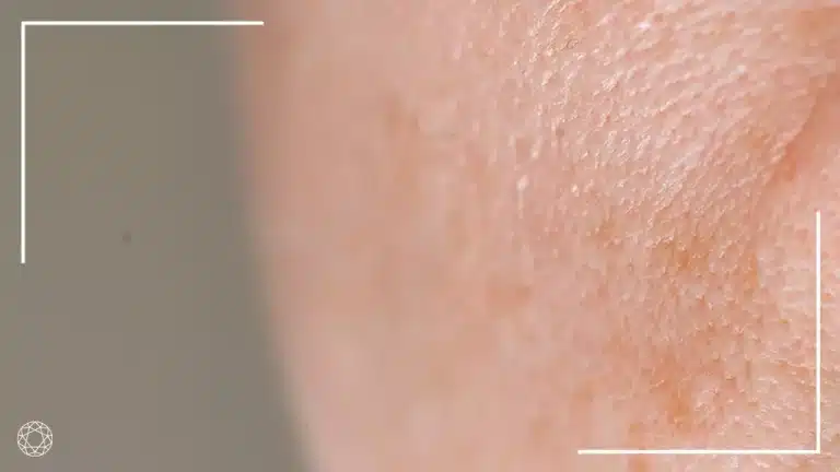 pori dilatati vs cicatrici acne