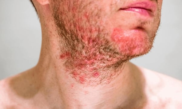 dermatite seborroica barba