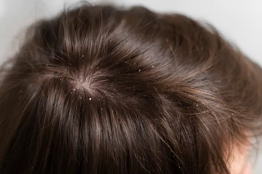 dermatite seborroica capelli foto