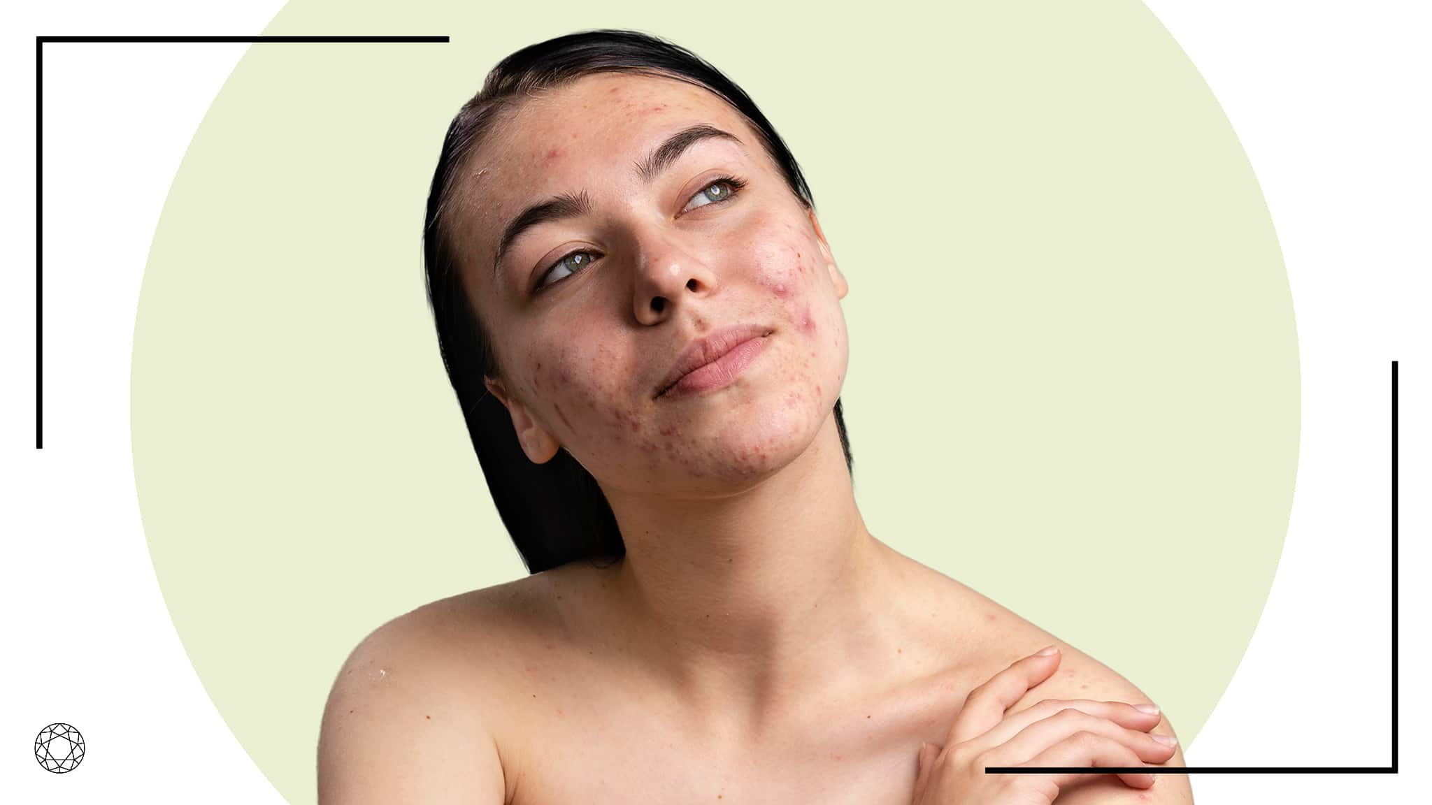 acne cause