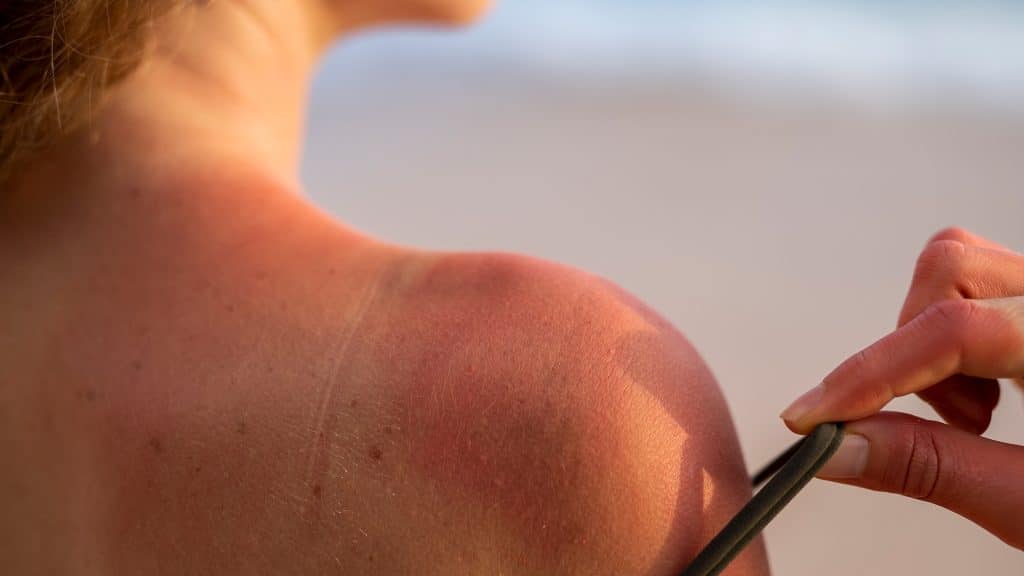 come lenire le scottature da sole