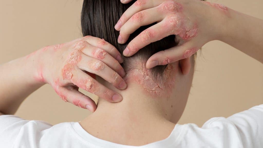 psoriasi a placche su mani e cuoio capelluto