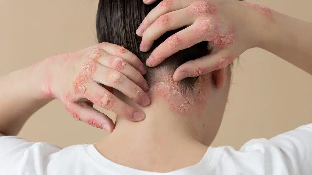 psoriasi a placche su mani e cuoio capelluto