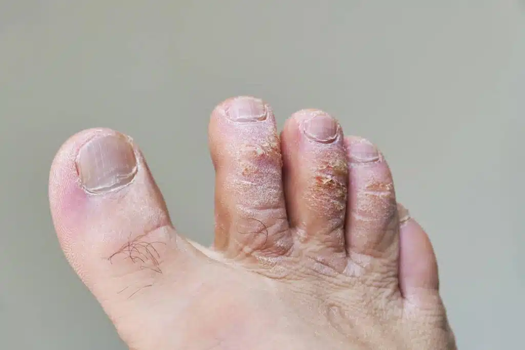 psoriasi unghie piedi foto