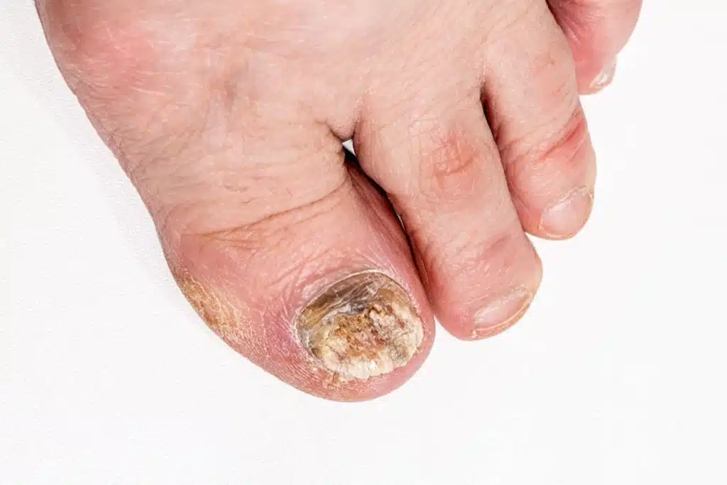 psoriasi unghie piedi
