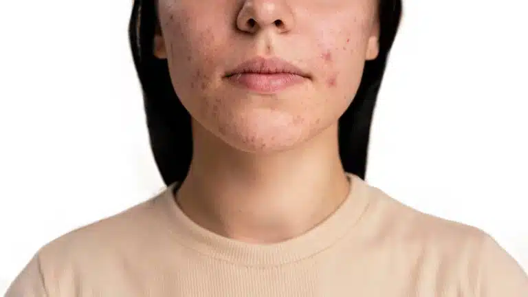 tipi di acne