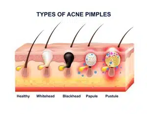 sintomi acne