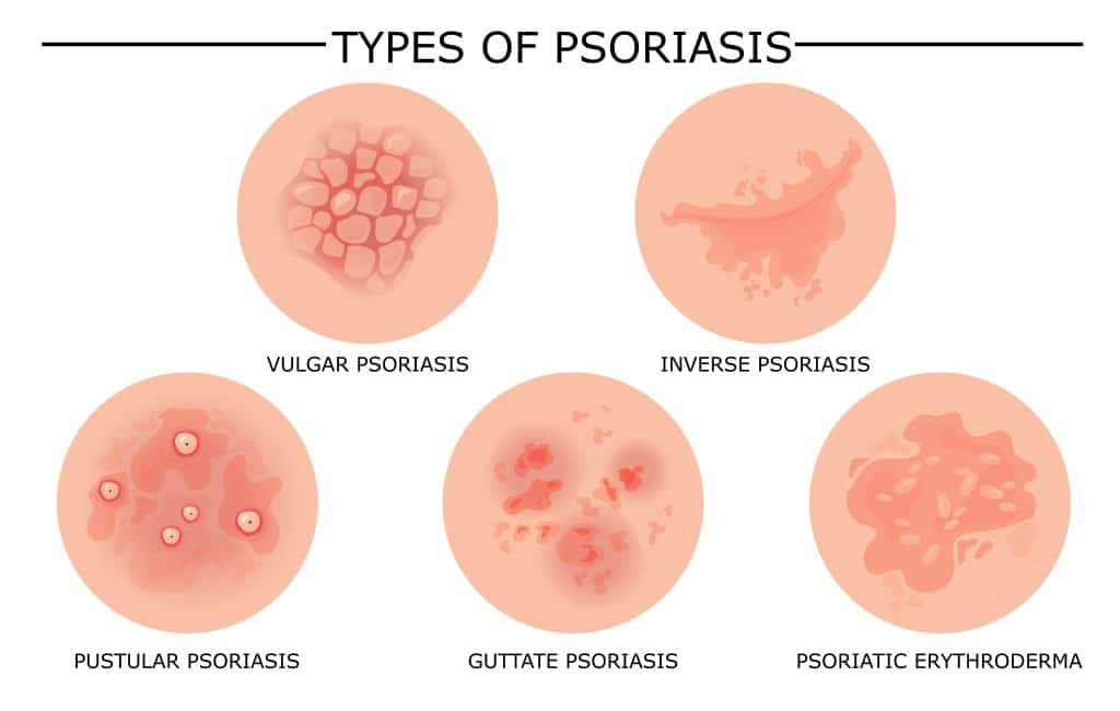 tipologie di psoriasi
