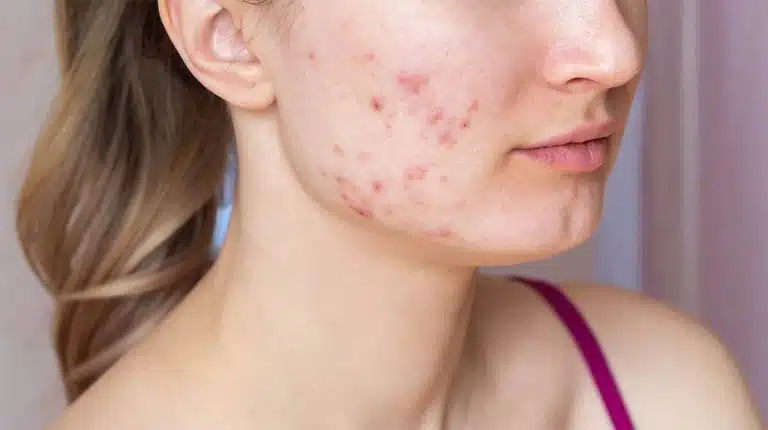 acne definizione e tipologie