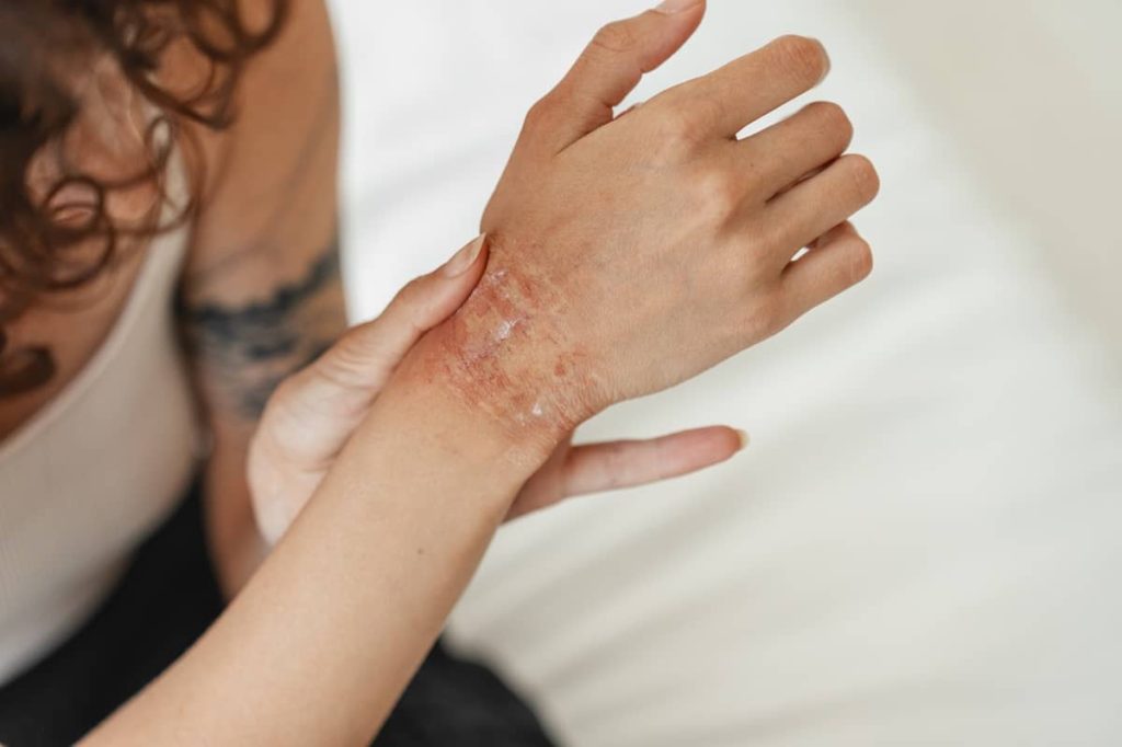 dermatite atopica immagine