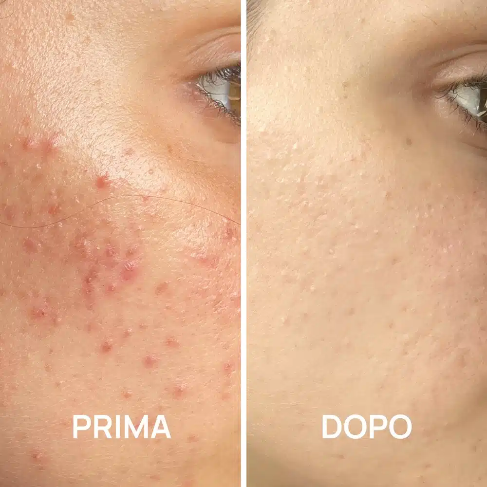 Foto prima e dopo acne con trattamenti PlantaDea