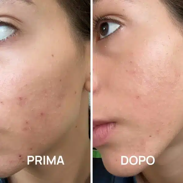 Foto prima e dopo acne con trattamenti PlantaDea