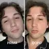 Foto prima e dopo acne con trattamenti PlantaDea
