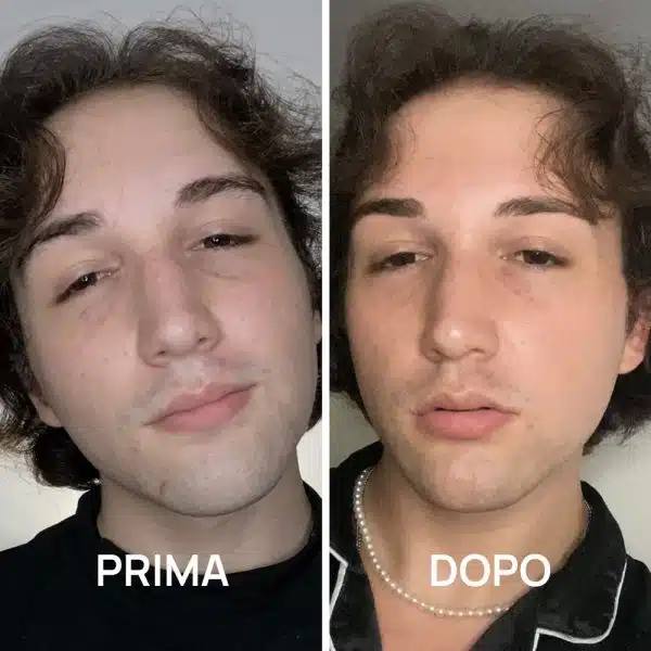 Foto prima e dopo acne con trattamenti PlantaDea