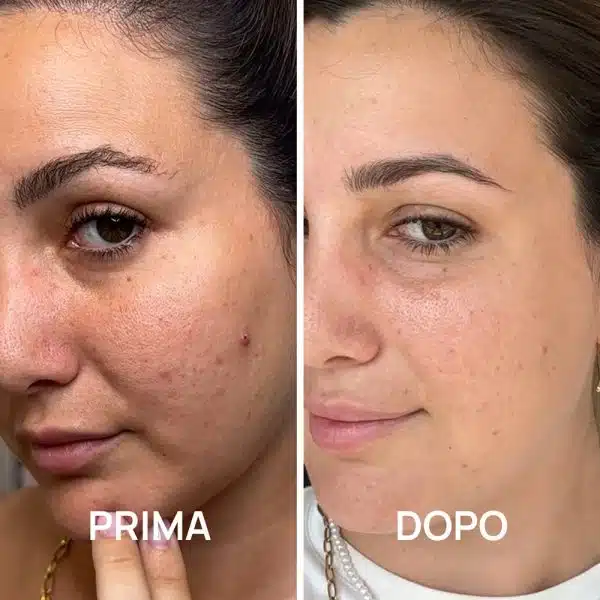 Foto prima e dopo acne con trattamenti PlantaDea