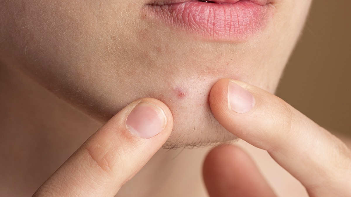 acne cistica