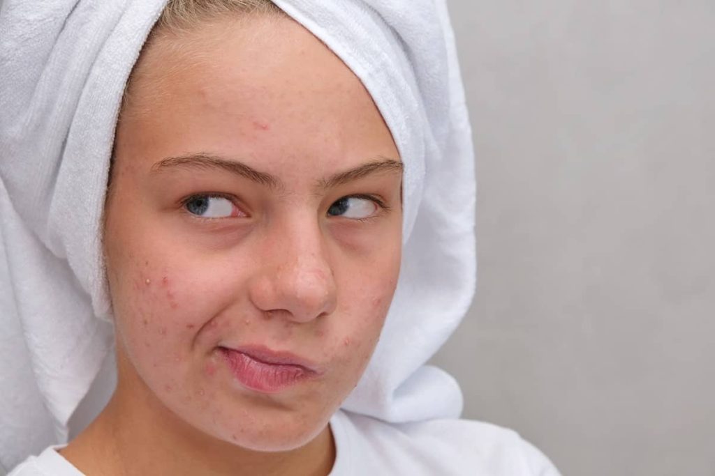 brufoli dopo pulizia viso