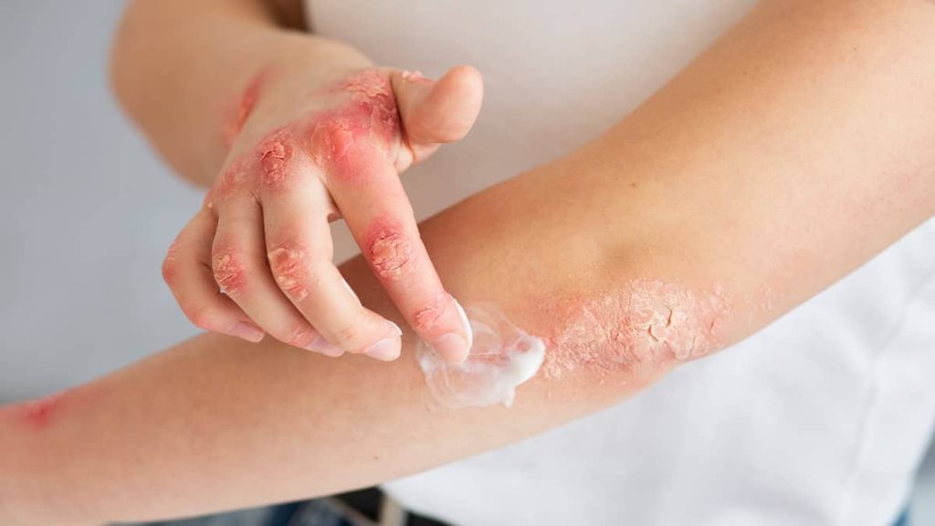 Braccia e mani di una persona con psoriasi: si vedono chiazze arrossate, screpolate e desquamate su gomiti e dita mentre il soggetto si applica una crema, evidenziando dolore e prurito legati alla malattia cronica della pelle.