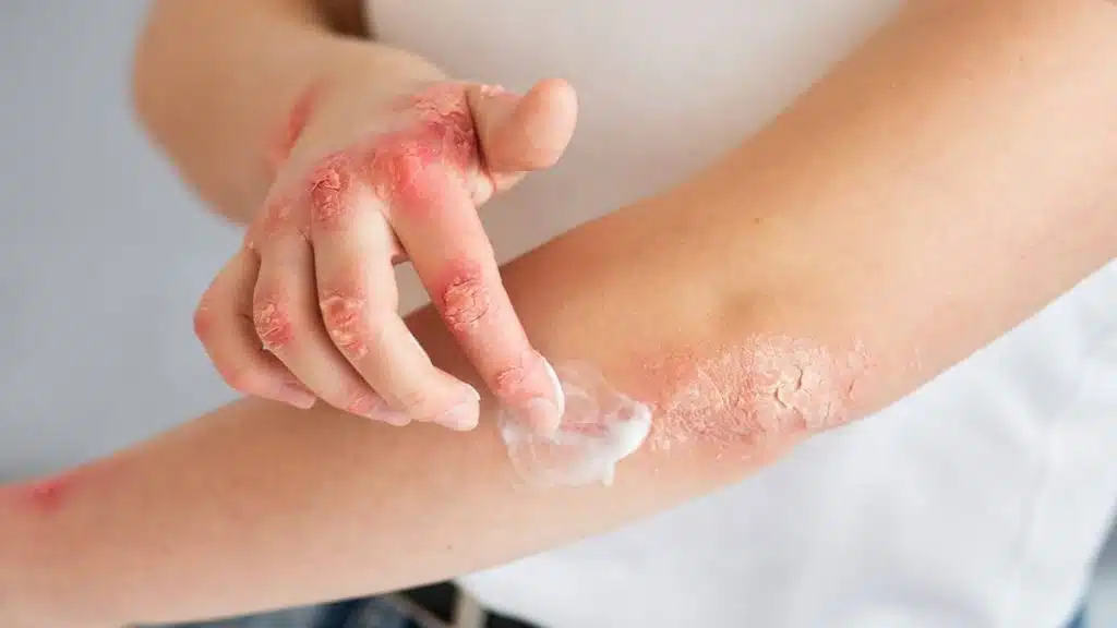 Braccia e mani di una persona con psoriasi: si vedono chiazze arrossate, screpolate e desquamate su gomiti e dita mentre il soggetto si applica una crema, evidenziando dolore e prurito legati alla malattia cronica della pelle.