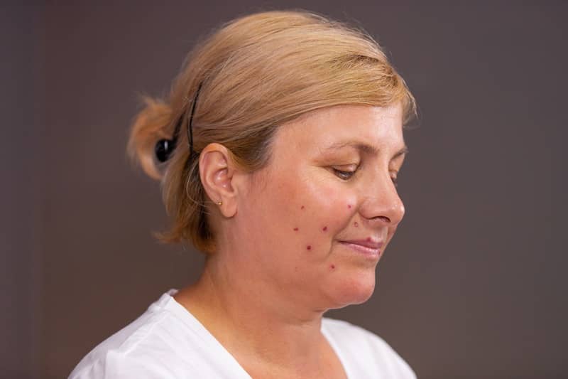 Donna di mezza età bionda con l'acne tardiva