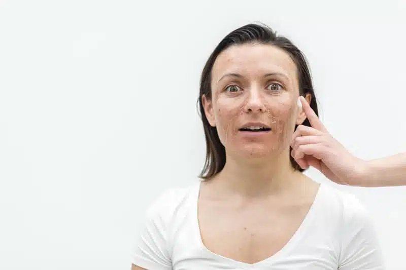 Donna di mezza età applica una crema sull'acne tardiva
