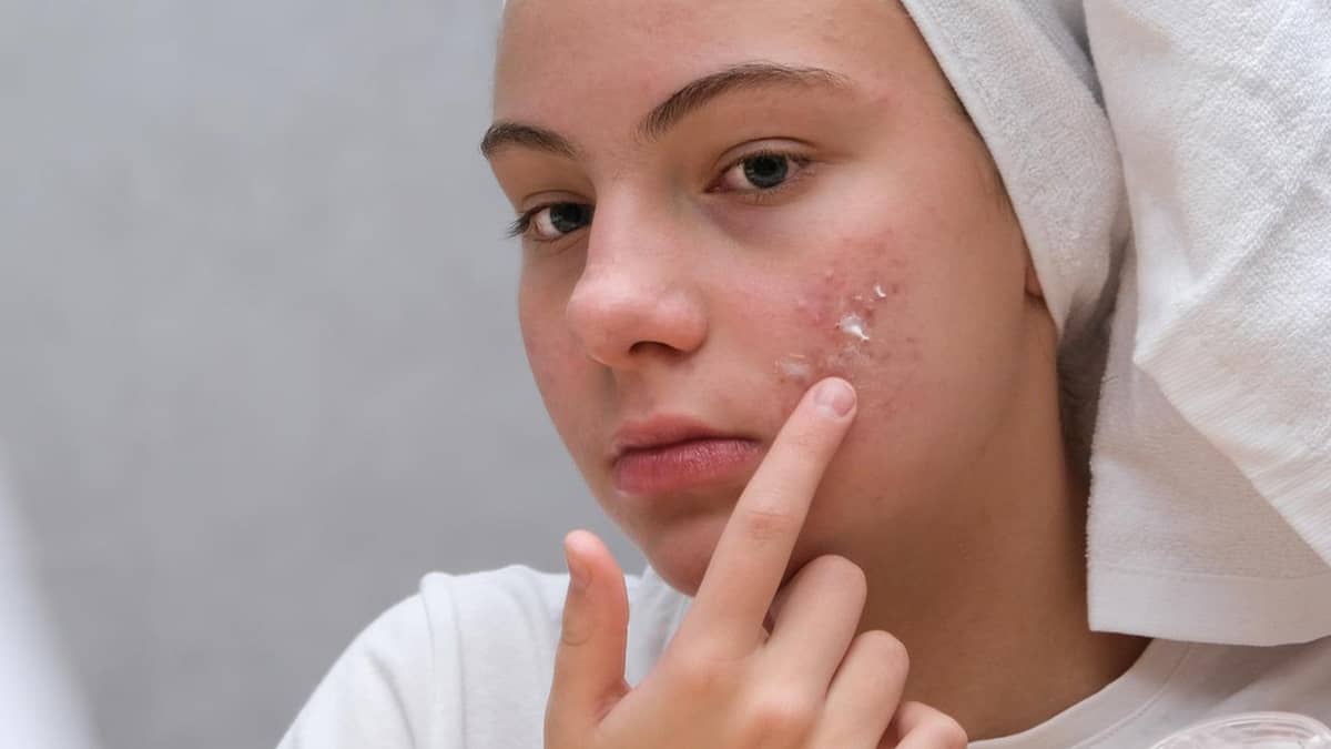 crema per acne ormonale