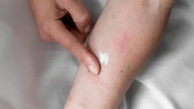 creme per dermatite atopica