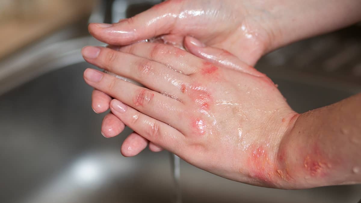 Donna si lava le mani con il miglior detergente per psoriasi