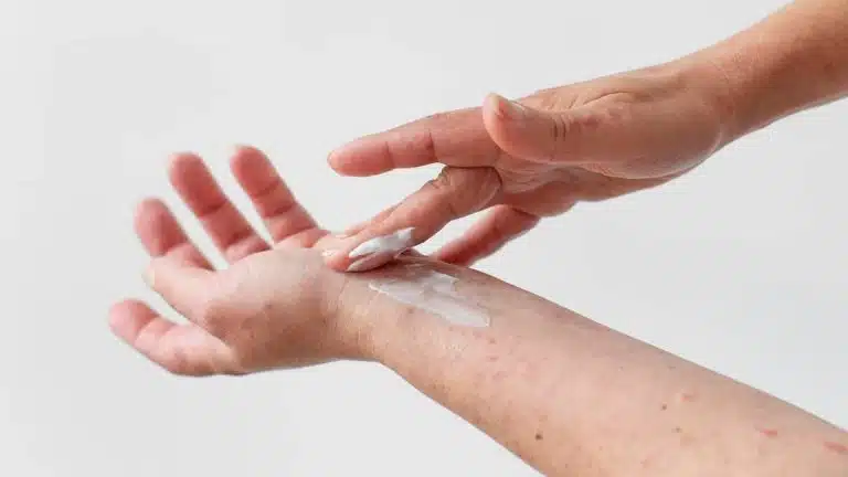 crema miracolosa per la dermatite atopica
