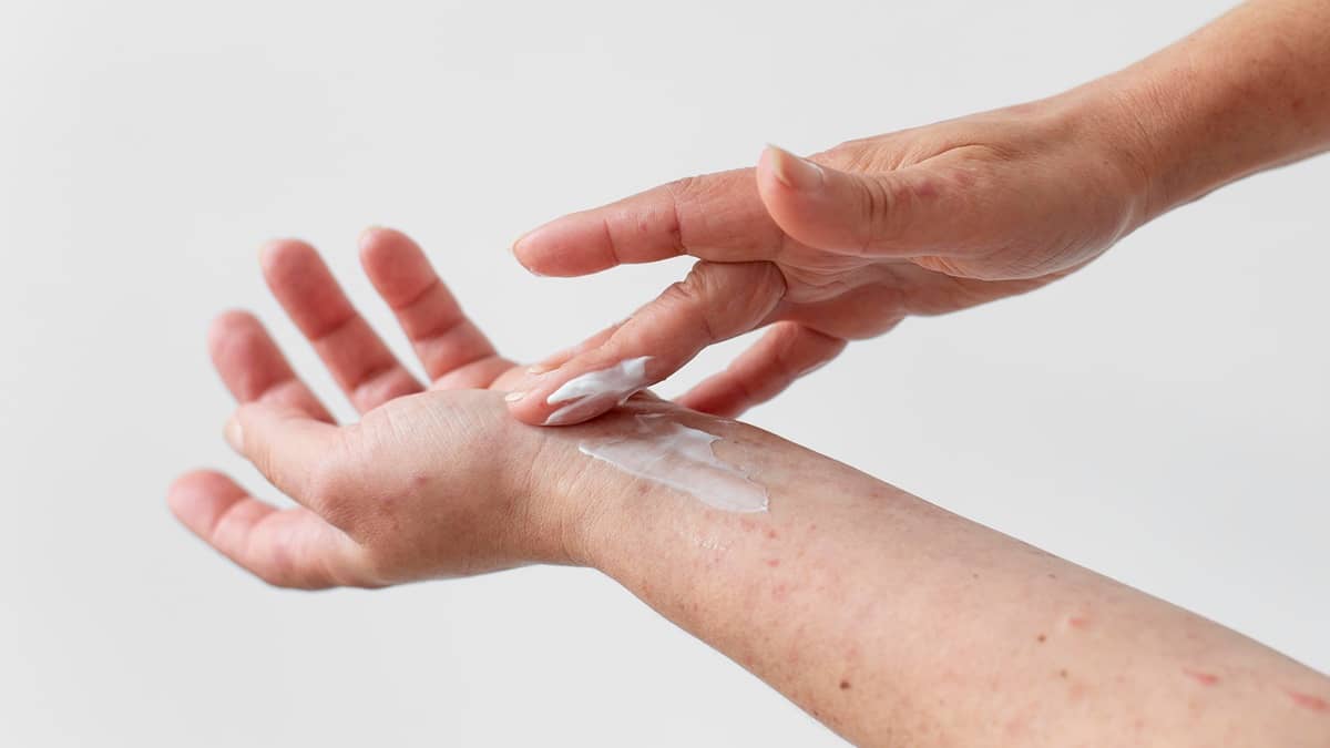 crema miracolosa per la dermatite atopica