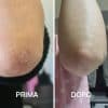 dermatite atopica foto prima e dopo PlantaDea