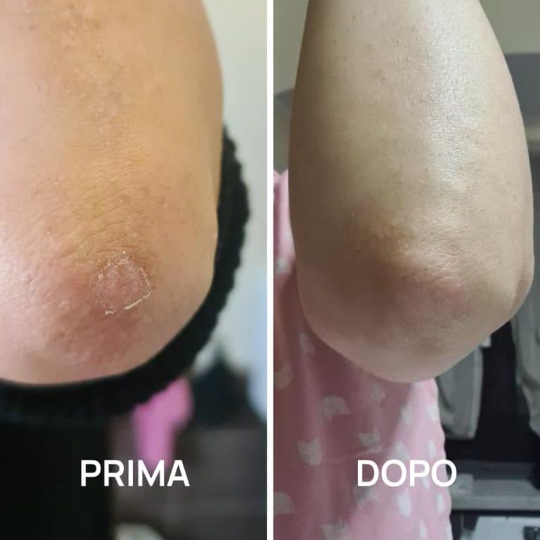 dermatite atopica foto prima e dopo PlantaDea