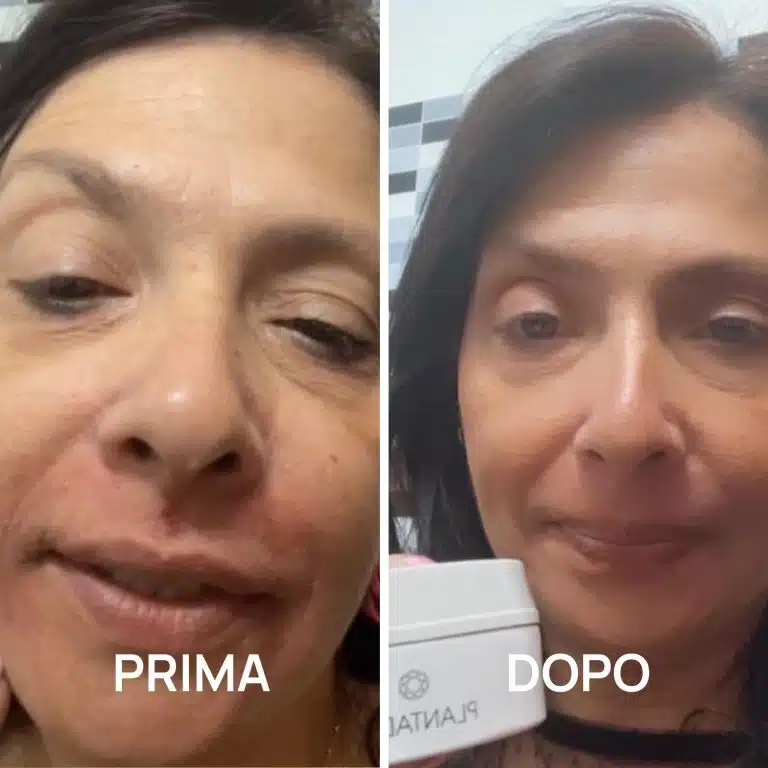 dermatite atopica foto prima e dopo PlantaDea