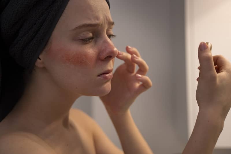 Donna con la dermatite atopica applica una crema per eliminarla