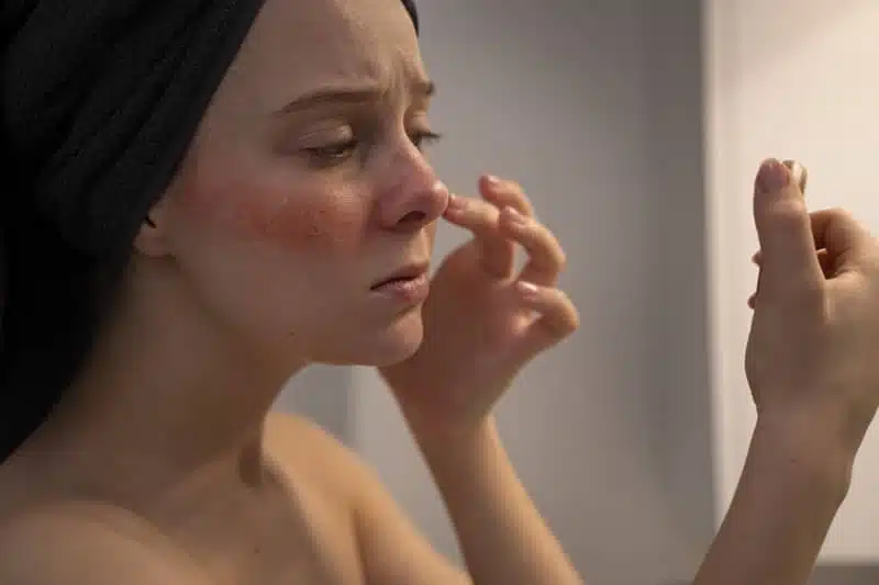Donna con la dermatite atopica applica una crema per eliminarla