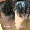 Foto psoriasi prima e dopo PlantaDea