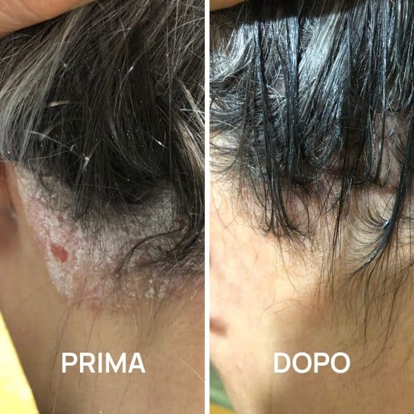 Foto psoriasi prima e dopo PlantaDea