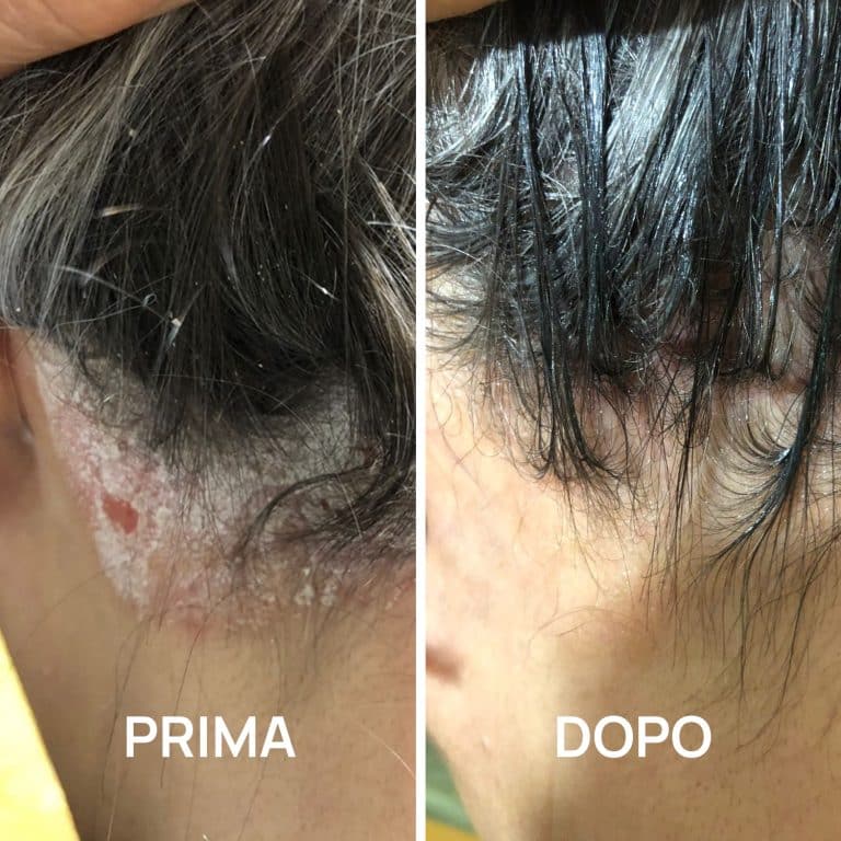 Foto psoriasi prima e dopo PlantaDea