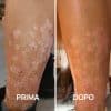 Foto psoriasi prima e dopo PlantaDea