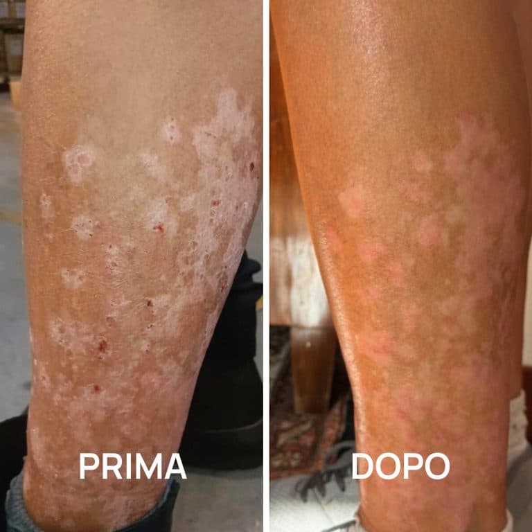Foto psoriasi prima e dopo PlantaDea