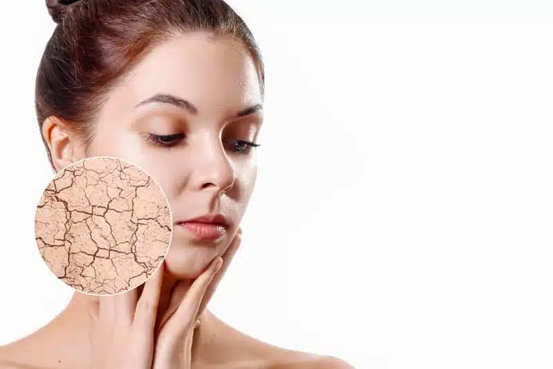 Giovane ragazza con la pelle del viso molto secca
