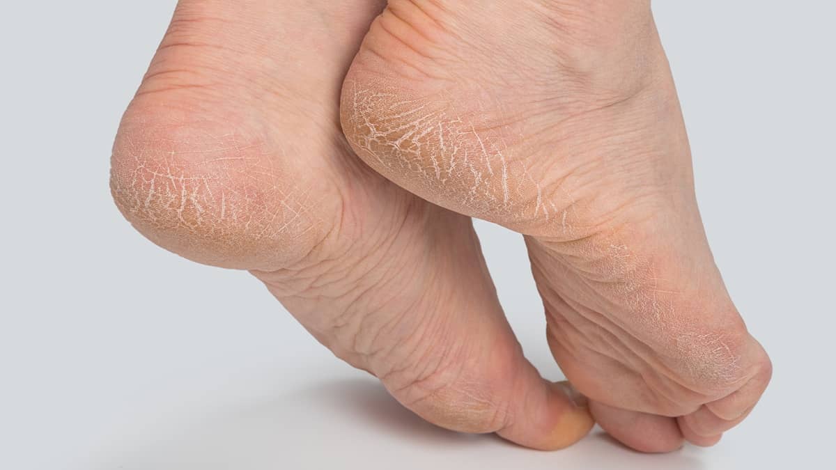 Foto di piedi secchi e screpolati