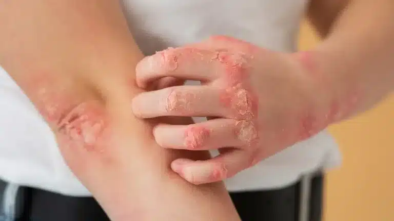 Psoriasi cura
