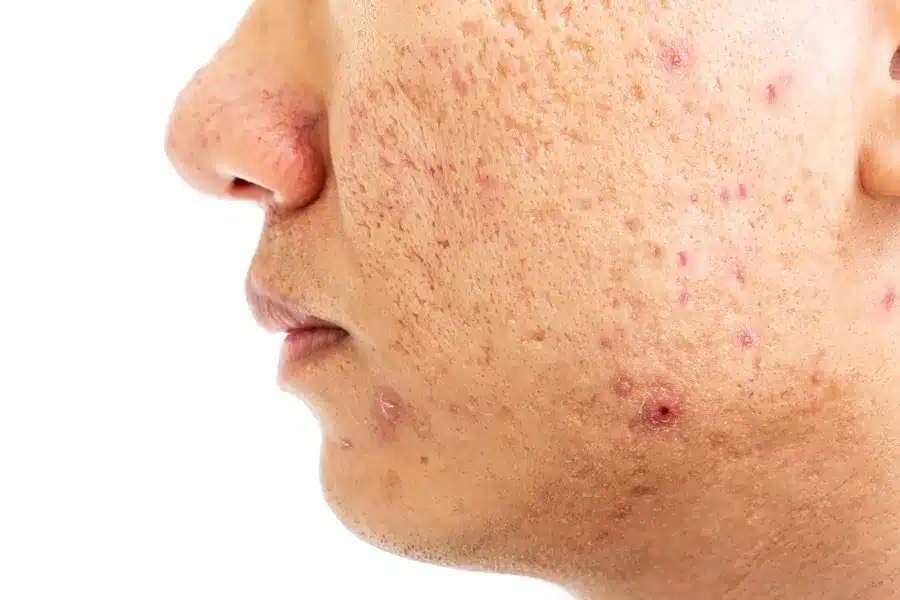Donna con cicatrici da acne e brufoli sottopelle