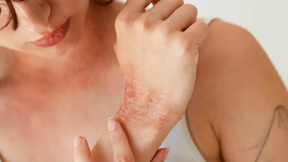 Inizio psoriasi