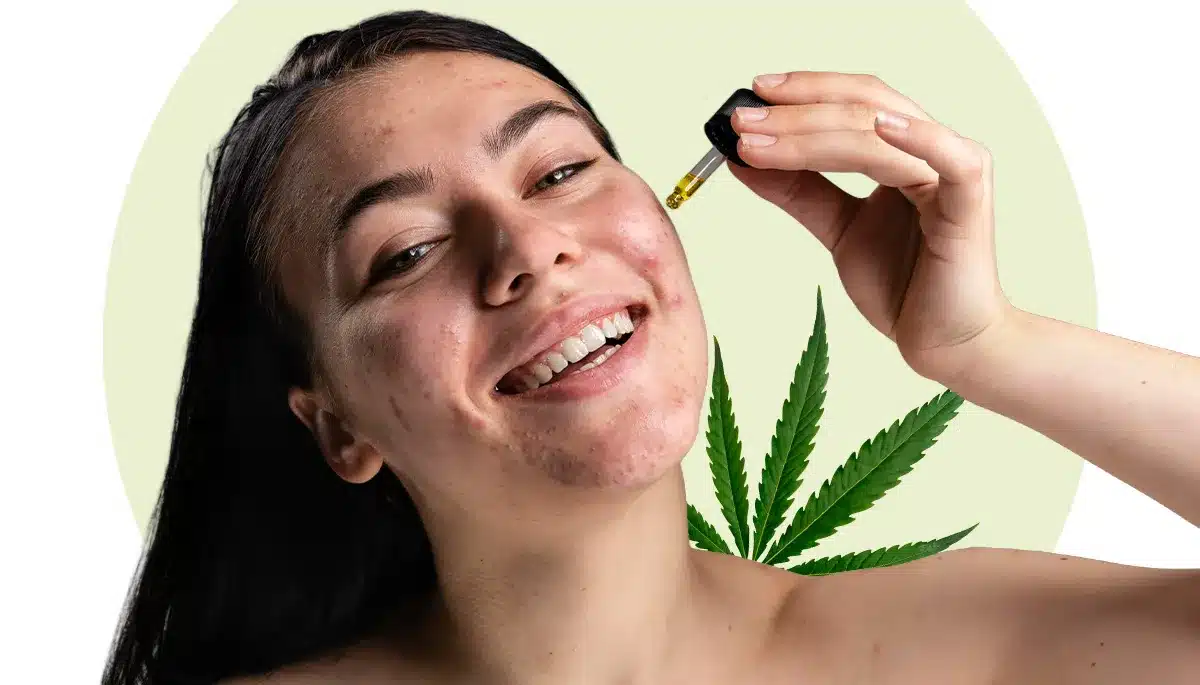 CBD acne