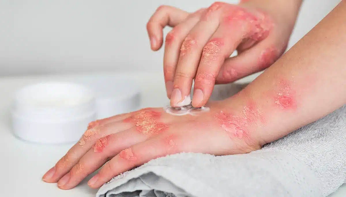 Come ammorbidire le croste della psoriasi
