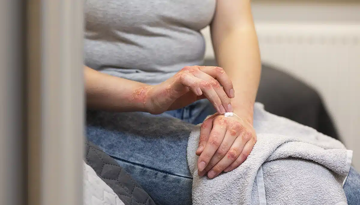 La psoriasi contagiosa