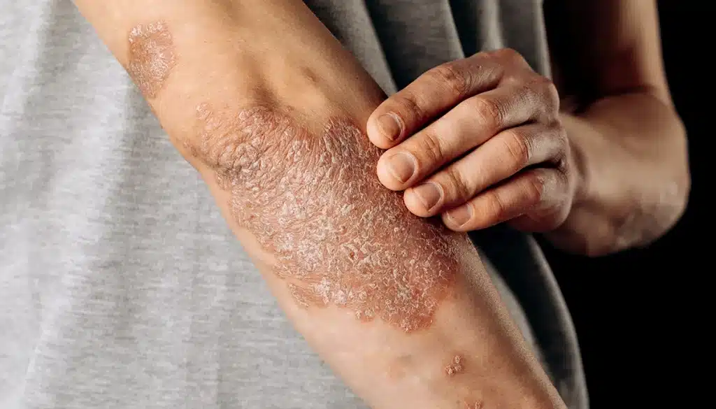 Braccio di una persona con psoriasi a placche: in primo piano si vedono chiazze arrossate e desquamate sulla pelle mentre la mano si avvicina per grattare, a evidenziare prurito e fastidio causati dalla malattia cronica.